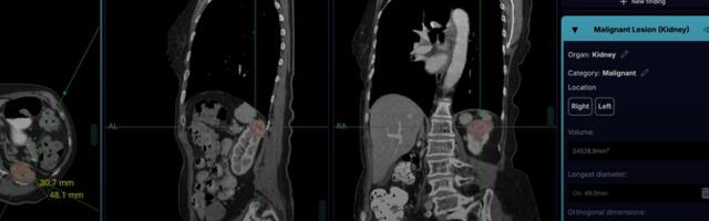 Tehisaru aitab neeruvähki kiiremini avastada