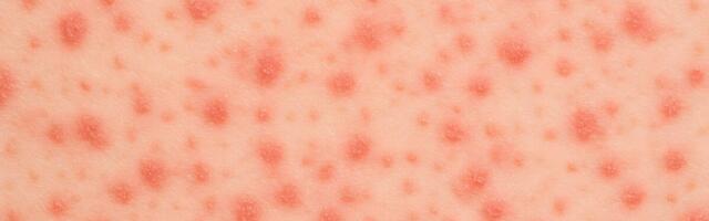 Lätis nakatus alternatiivmeditsiini seminaril osalenu leetritesse