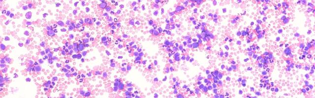 Uus geeniteraapia meetod aitas Briti arstidel päästa rasket leukeemiavormi põdenud patsiente